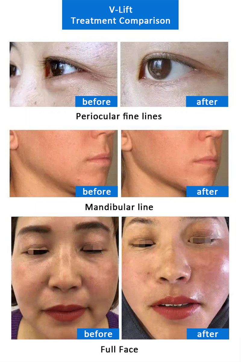 V-LIFT RF Anti-Aging Skin Lifting/Tightening \u0026 Wrinkles Removal - HONKON  Laser