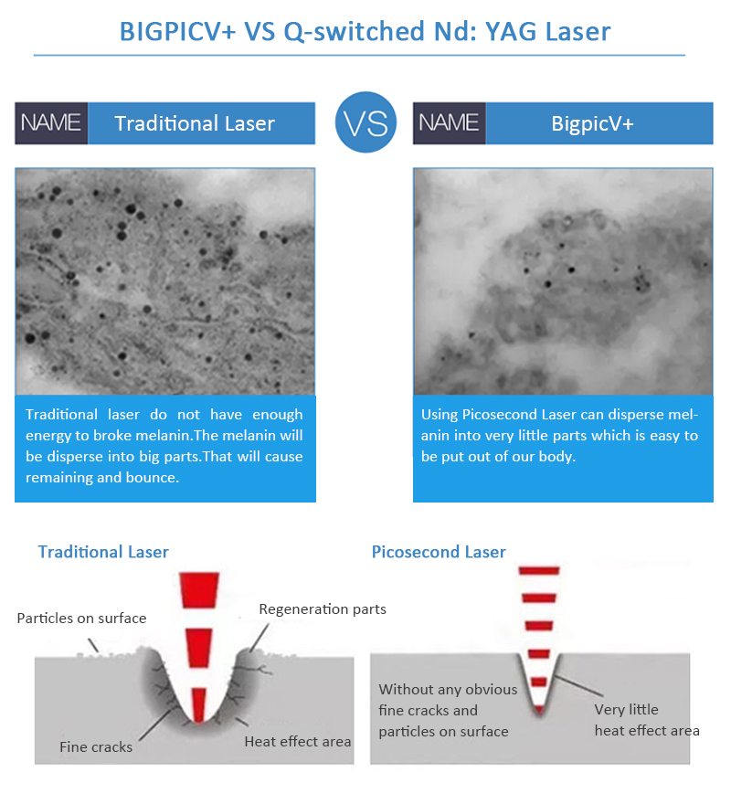 Bigpic V+ Cost-Effective Picolaser/Picosecond Laser Pigment Lesions Tattoo Removal Machine 