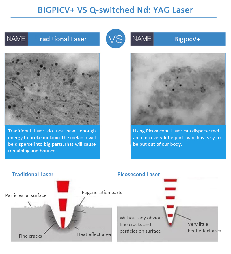 Bigpic V+ Effektiv Pikolazer/Pikosaniyəlik Lazer Piqment Lezyonları Tatu Silmə Maşını