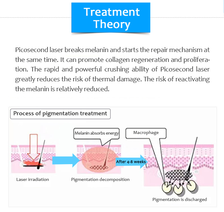 1064QPH01 Բարձր որակի Picolaser/Picosecond Laser Pigment Lesions Tattoo Removal Luxurious Equipment