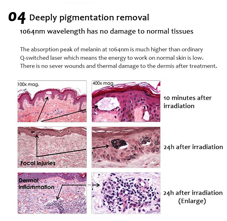 1064QPH01 Բարձր որակի Picolaser/Picosecond Laser Pigment Lesions Tattoo Removal Luxurious Equipment