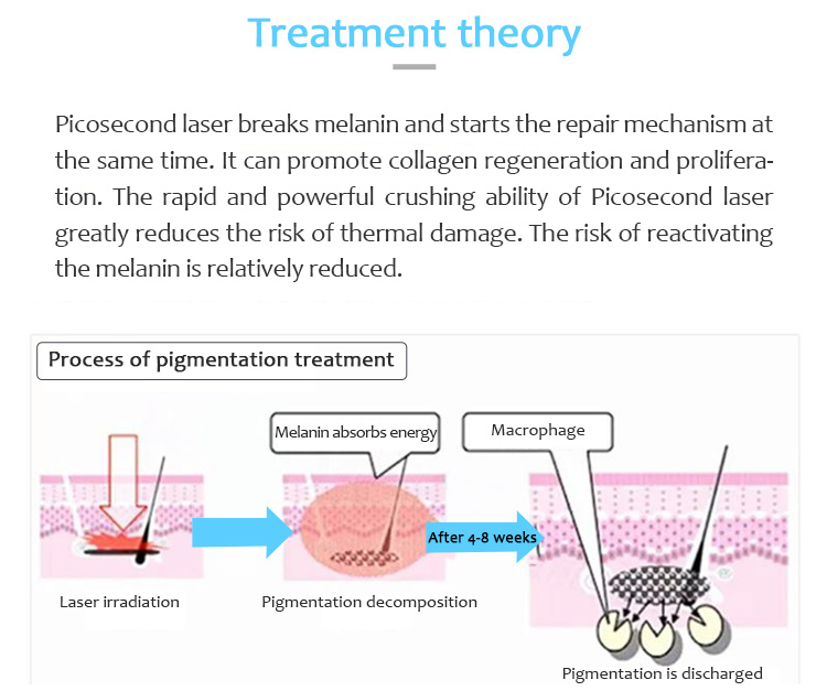 Máquina de eliminación de tatuajes con láser, Láser de picosegundo, Máquina de eliminación de lesiones pigmentarias, 1064PQE+