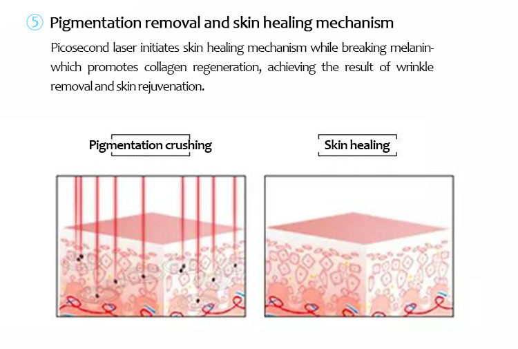 Máquina de eliminación de tatuajes con láser, Láser de picosegundo, Máquina de eliminación de lesiones pigmentarias, 1064PQE+