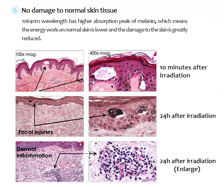 Máquina de eliminación de tatuajes con láser, Láser de picosegundo, Máquina de eliminación de lesiones pigmentarias, 1064PQE+