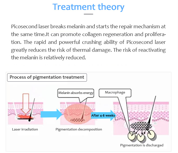 Máquina de eliminación de tatuajes con láser, Láser de picosegundo, Máquina de eliminación de lesiones pigmentarias, 1064pvyl+