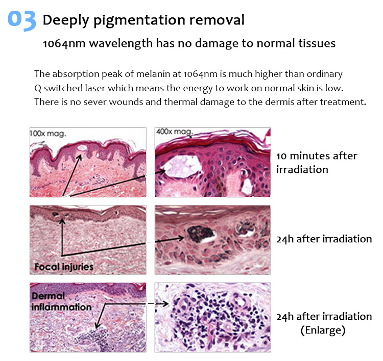 Máquina de eliminación de tatuajes con láser, Láser de picosegundo, Máquina de eliminación de lesiones pigmentarias, 1064pvyl+