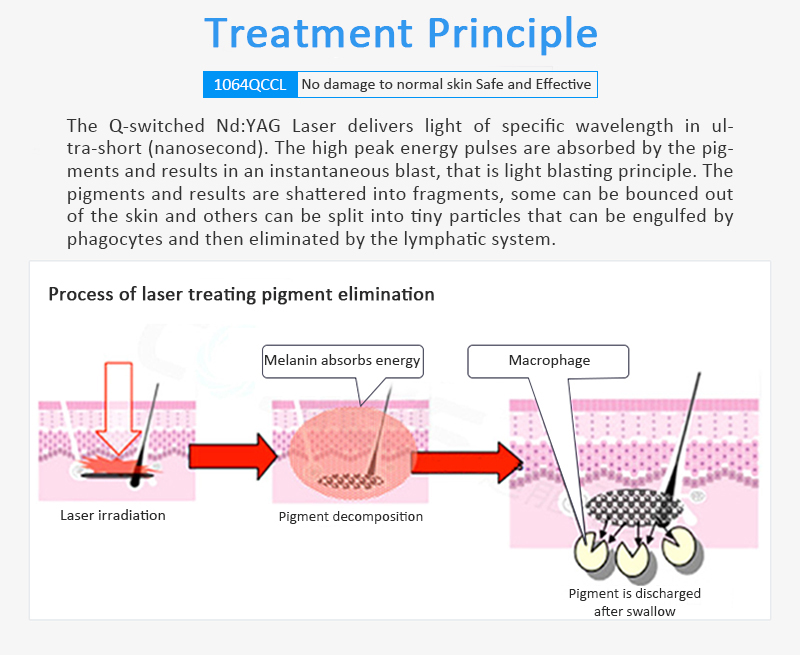 Láser ND:YAG Q-Switched de 1064 nm, Máquina de eliminación de tatuajes con láser, Máquina de eliminación de lesiones pigmentarias, 1064QCCL