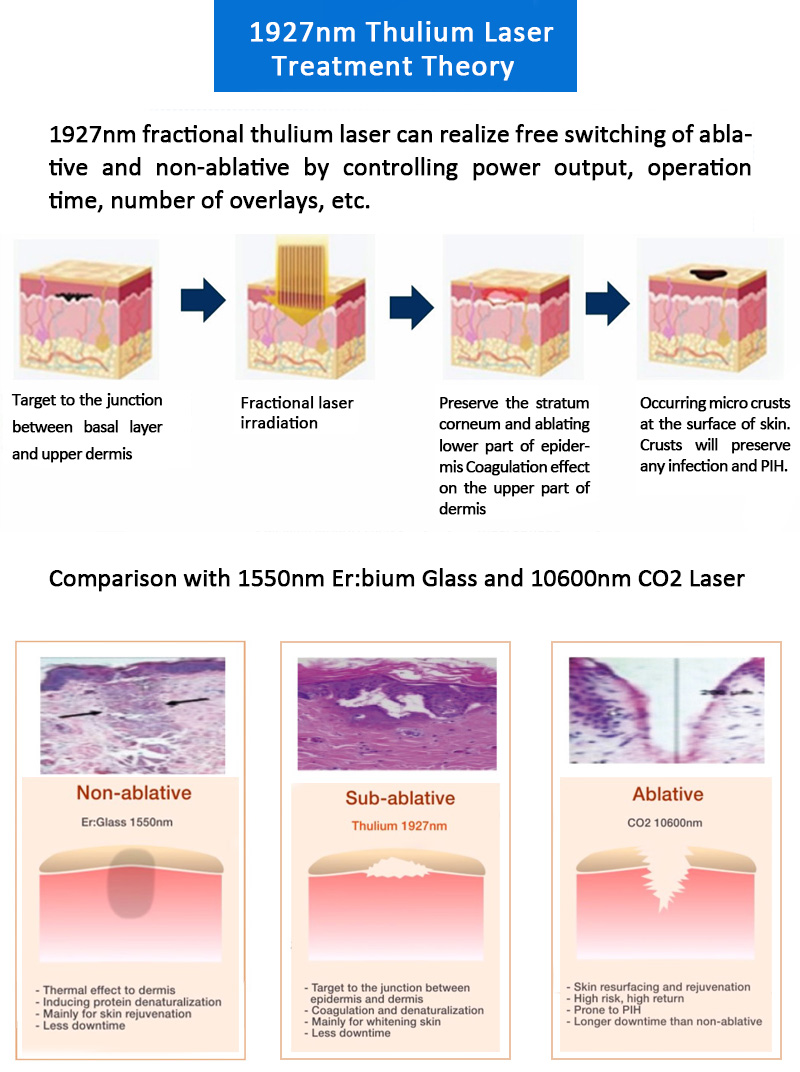 1927nm Thulium Laser, Facial & Skin Resurfacing Machine, Scars & Acne Scars Removal Machine, 1927KK