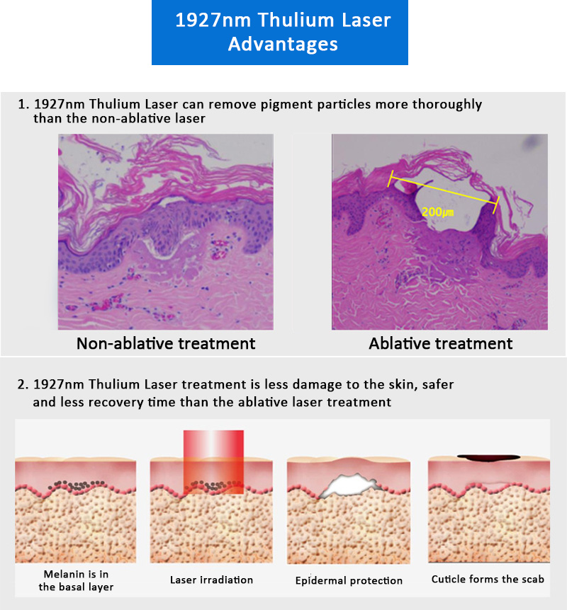 1927nm Thulium Laser, Facial & Skin Resurfacing Machine, Scars & Acne Scars Removal Machine, 1927KK