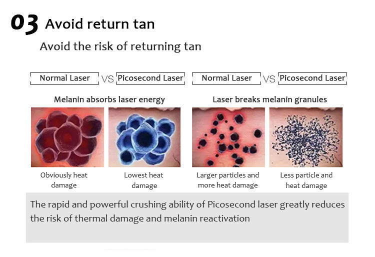 1064QPH03 Plus Picolaser Máquina de eliminación de pigmentación para eliminación de tatuajes con láser de picosegundo