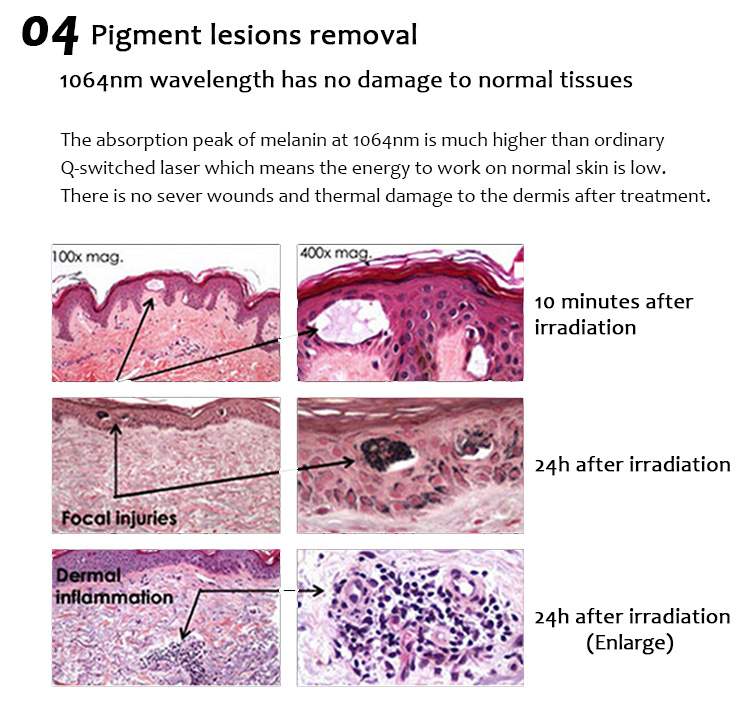 1064QPH03 Plus Picolaser Máquina de eliminación de pigmentación para eliminación de tatuajes con láser de picosegundo