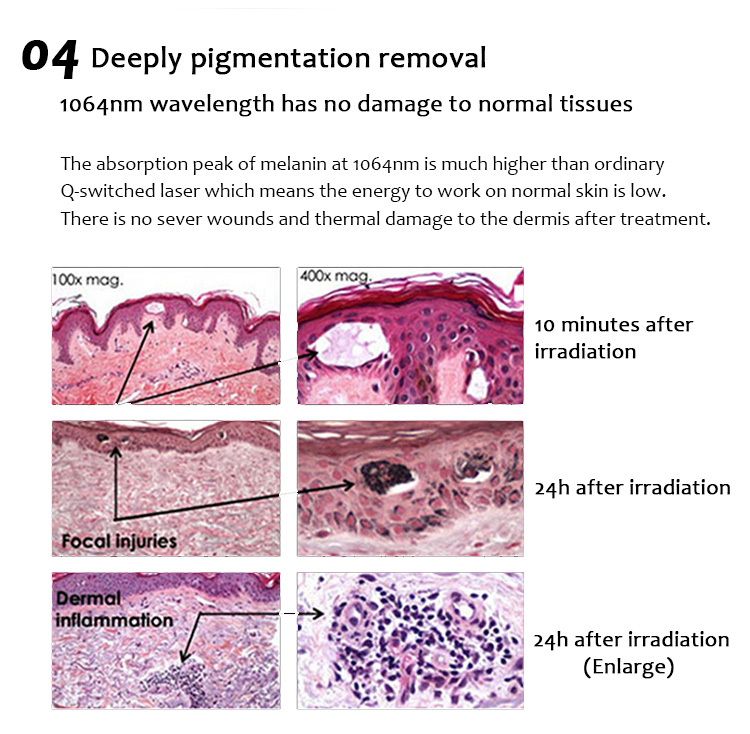 1064QPH03 Picolaser pikosekundinė tatuiruotės šalinimo lazeriu įranga pigmentacijos šalinimui