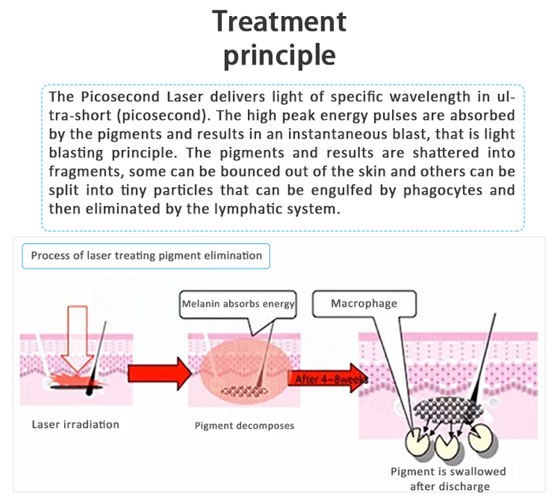 Bigpic V+ Máquina rentable de eliminación de tatuajes con picolaser/láser de picosegundo para lesiones pigmentarias