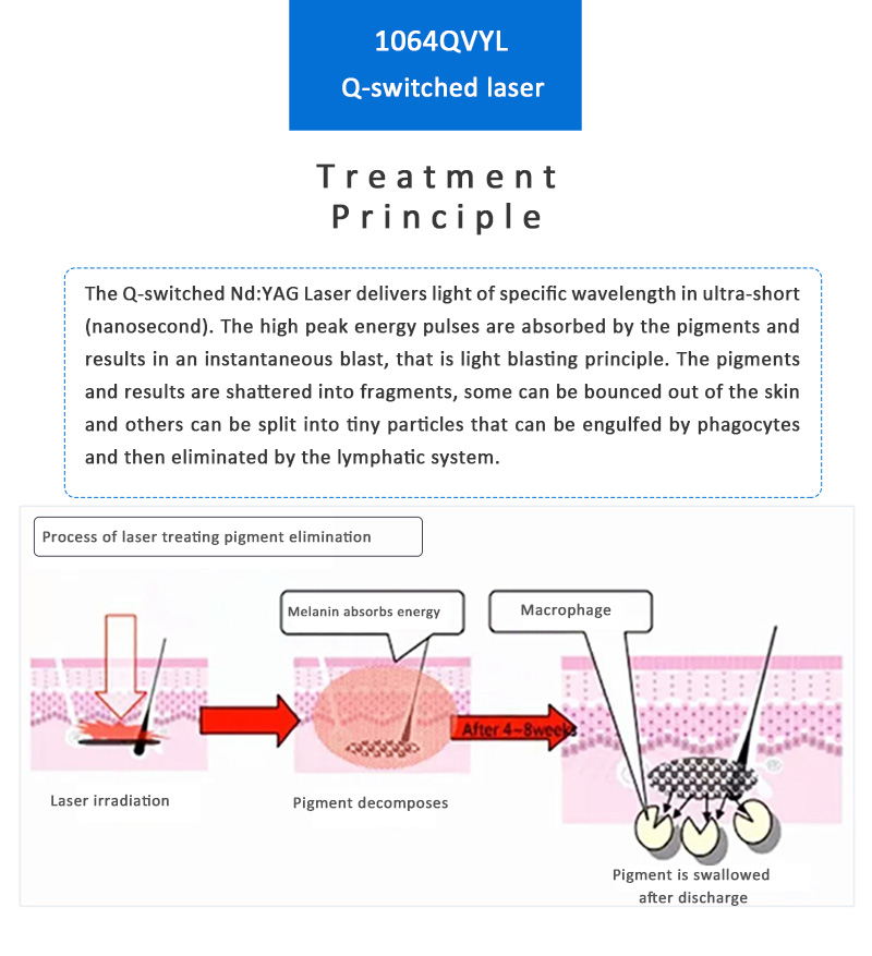 Láser ND:YAG con conmutación Q de 1064 nm, máquina de eliminación de tatuajes con láser, máquina de eliminación de lesiones pigmentarias, 1064QVYL