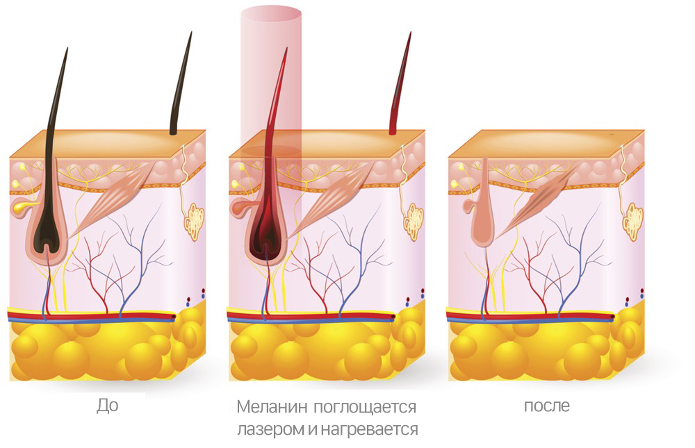 шашты лазерлік кетіру - бұл қалай жұмыс істейді