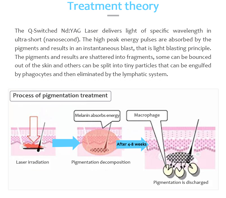 1064QVYH Q-Switched Nd:YAG Máquina de eliminación de lesiones pigmentarias y tatuajes con láser