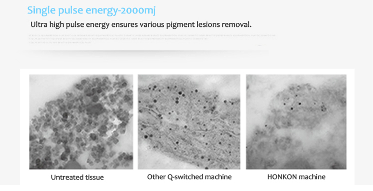 1064QVYH Q-Switched Nd:YAG Máquina de eliminación de lesiones pigmentarias y tatuajes con láser