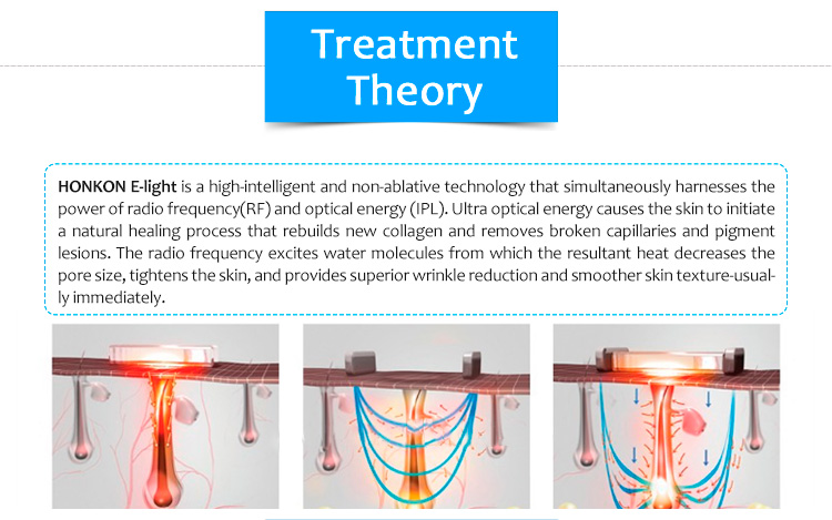 QQ+E Cute02 Depilación IPL/E-Light portátil Rejuvenecimiento de la piel Pigmentación Lesión vascular