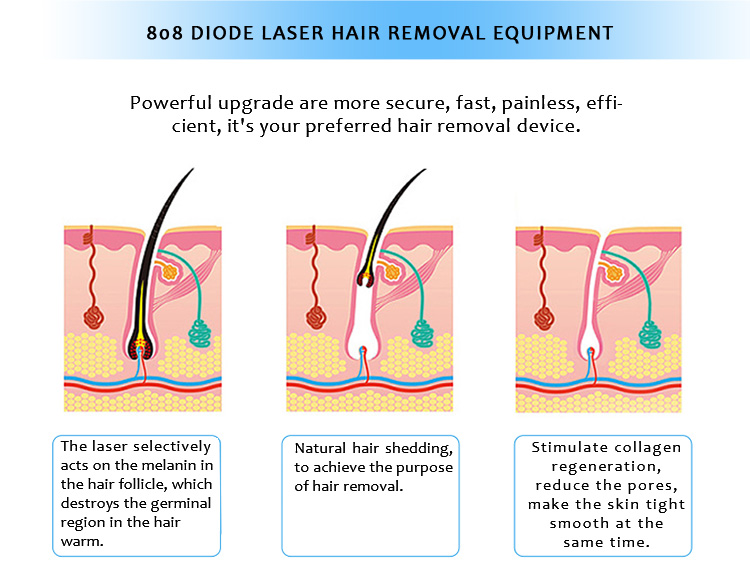 808KK 808nm Diode Laser SHR Permanent Hair Removal Skin Rejuvenation Machine