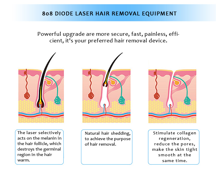 808XF 808nm Diode Laser Permanent Hair Removal Skin rejuvenation Machine