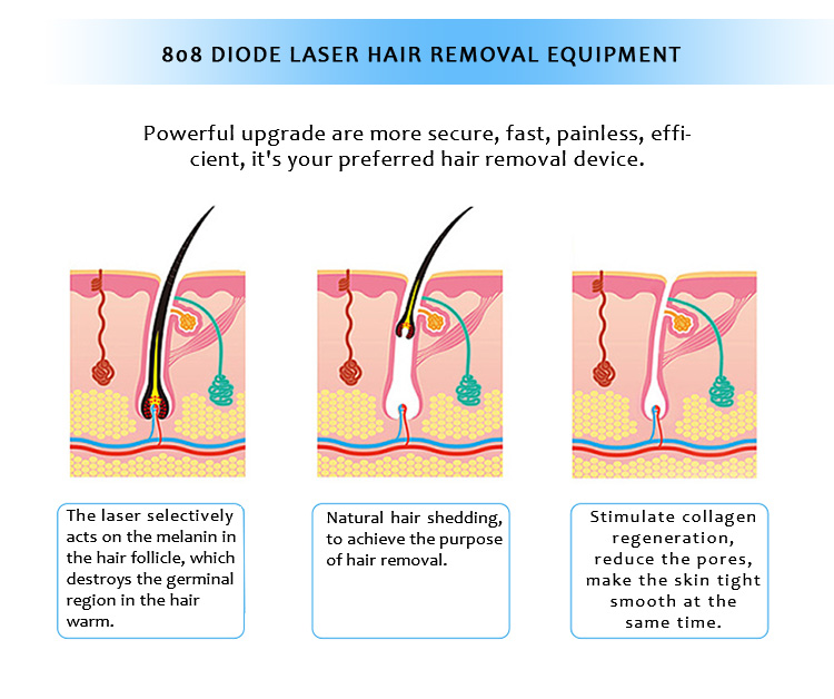 808AL-01 808nm Diode Laser Permanent Hair Removal Machine 