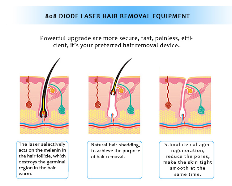 808CL-01 808nm Diod Lazer Daimi Epilyasiya Maşını