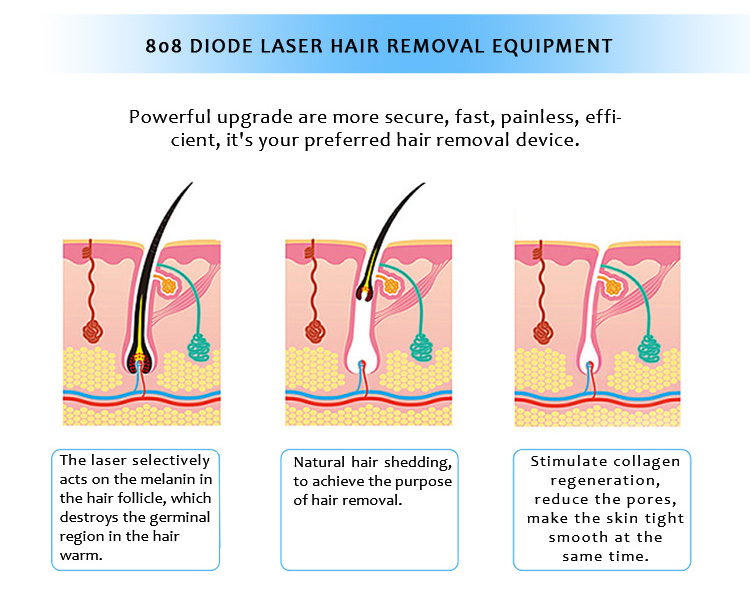 808CUTE03 808nm Diode Laser Permanent Hair Removal Machine