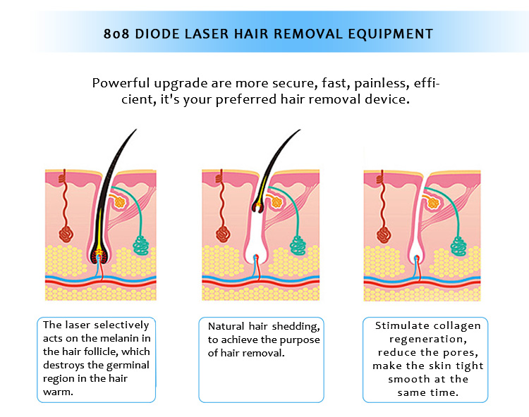 808CUTE 808nm Diode Laser Permanent Hair Removal Machine