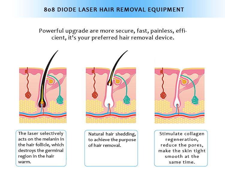 DL9999 808nm diodes lāzera pastāvīga matu noņemšanas iekārta