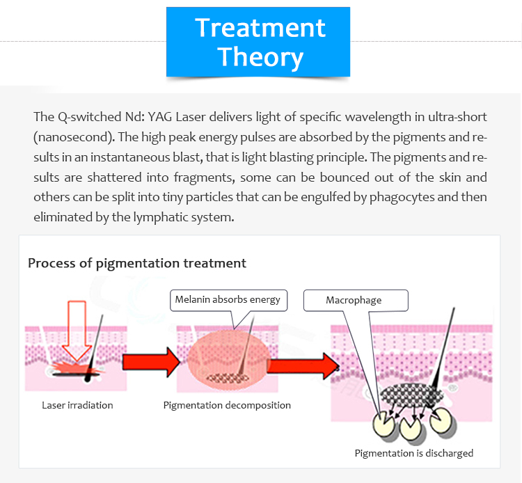 1064nm Q-Switched ND:YAG Laser, Laser Tattoo Removal Machine,Bigpic-pro