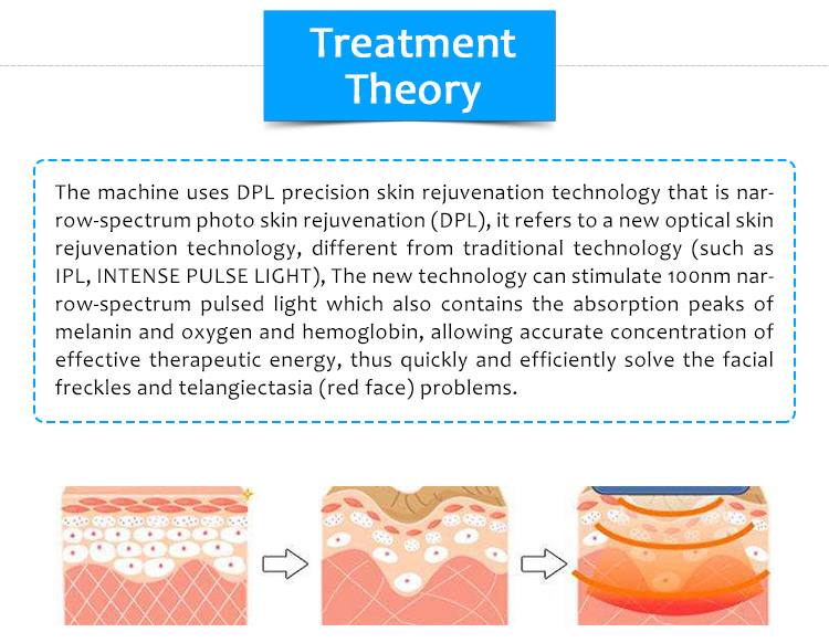 Máquina de depilación láser de diodo, IPL/E-Light/OPT/DPL, Máquina de eliminación de lesiones pigmentarias, Máquina de eliminación de cicatrices y cicatrices de acné, Máquina de eliminación vascular, DPL-one