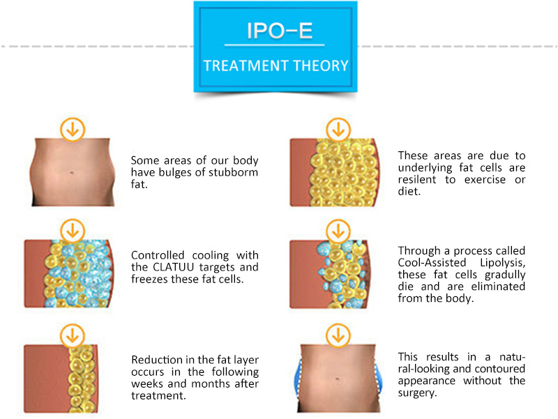 IPO-E Cryolipolysis арықтататын құрылғы Криолиполиз құрылғысы Криолиполизге арналған құрылғы