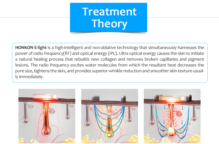 M90e Ipl/E-Light Depilación Rejuvenecimiento de la piel Rf bipolar Estiramiento y elevación de la piel