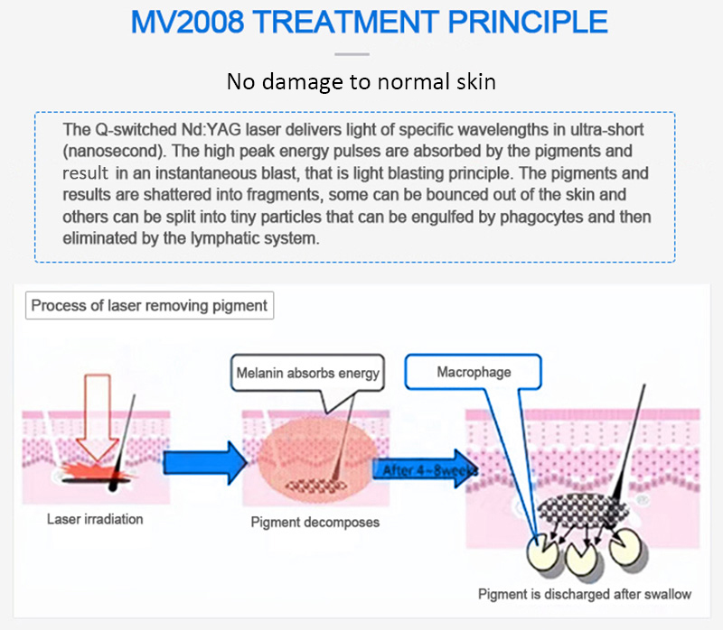 Láser ND:YAG con conmutación Q de 1064 nm, máquina de eliminación de tatuajes con láser, máquina de eliminación de lesiones pigmentarias, MV2008