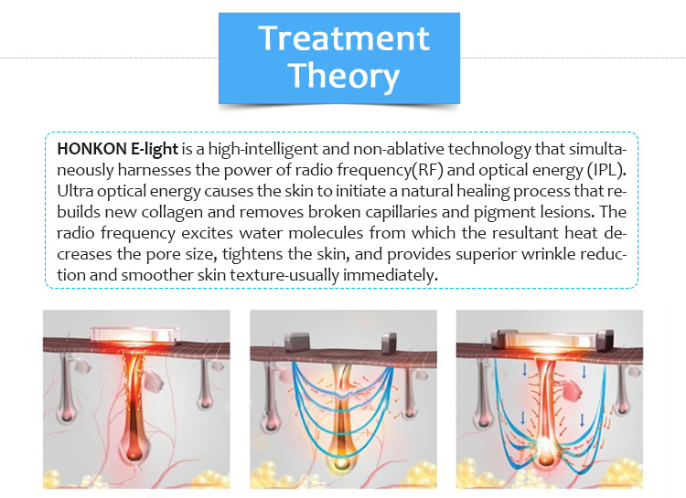 S1C+ IPL Hair Removal And Skin Tightening Of Multifunction Beauty Machine