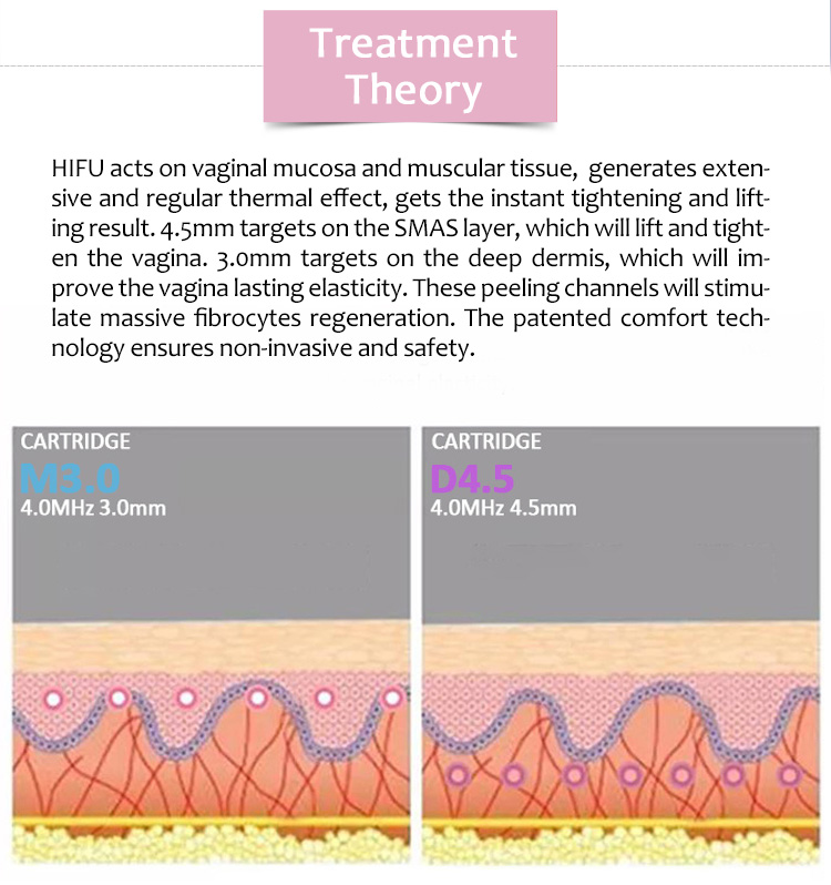 Máquina de belleza para tratamiento vaginal no invasivo de ajuste vaginal HIFU portátil SM-Smart