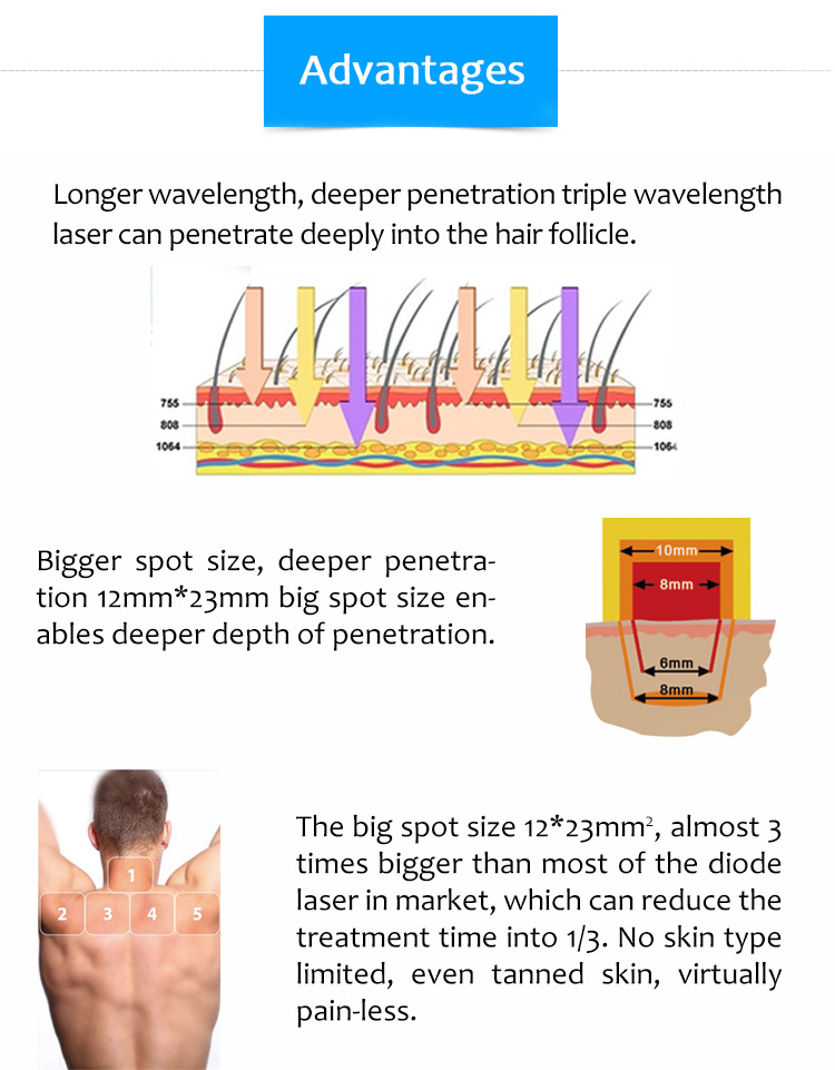 Láser ND:YAG con conmutación Q de 1064 nm, Láser de diodo de 808 nm, Máquina de depilación láser de diodo, Supreme ICE-E