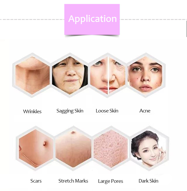 RF Skin Lifting & Tightening, Scars & Acne Scars Removal Machine, WZ02