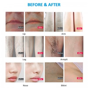 laser-hair-removal-how-it-works