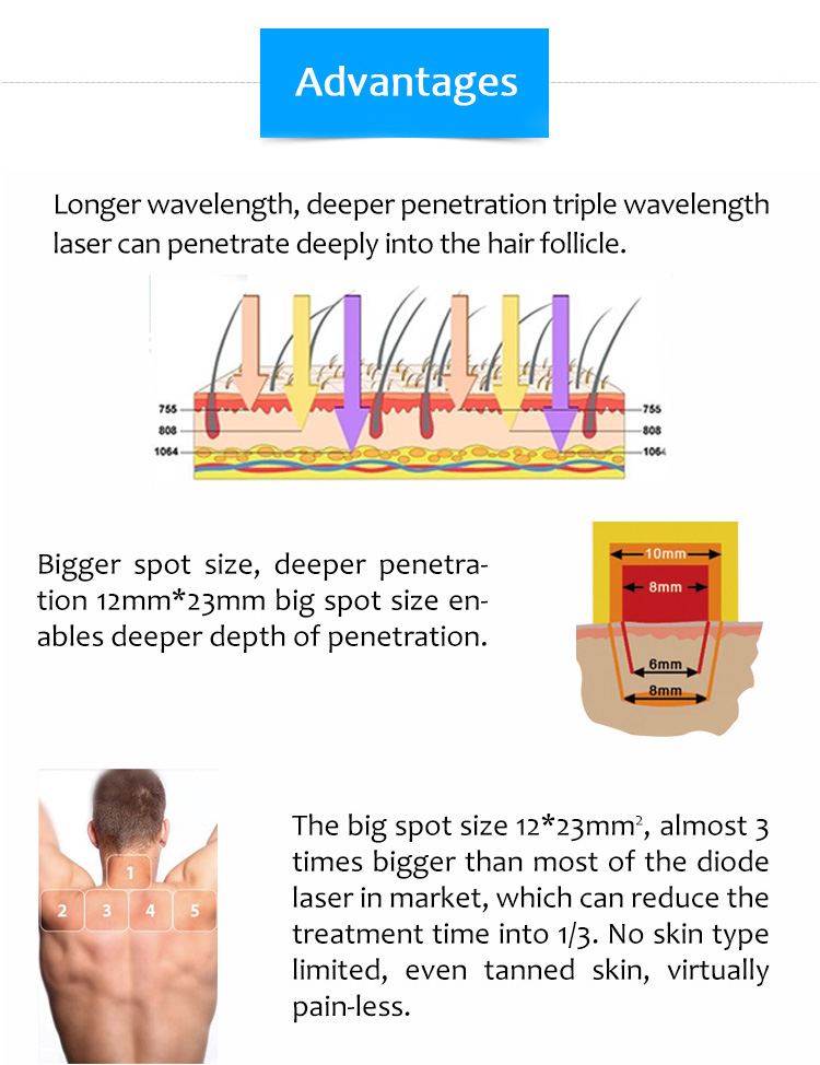 Supreme ICE-06 755nm 808nm 1064nm Diode Laser Permanent Hair Removal Machine