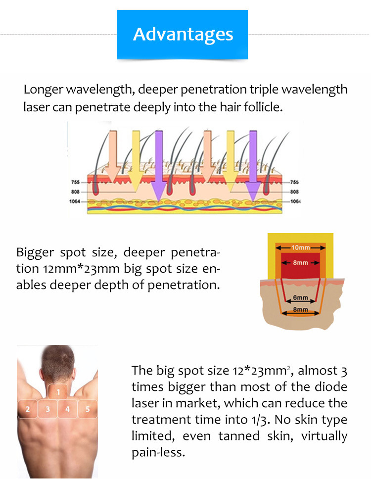 Supreme ICE-KK 755nm 808nm 1064nm Diode Laser Hair Removal Machine