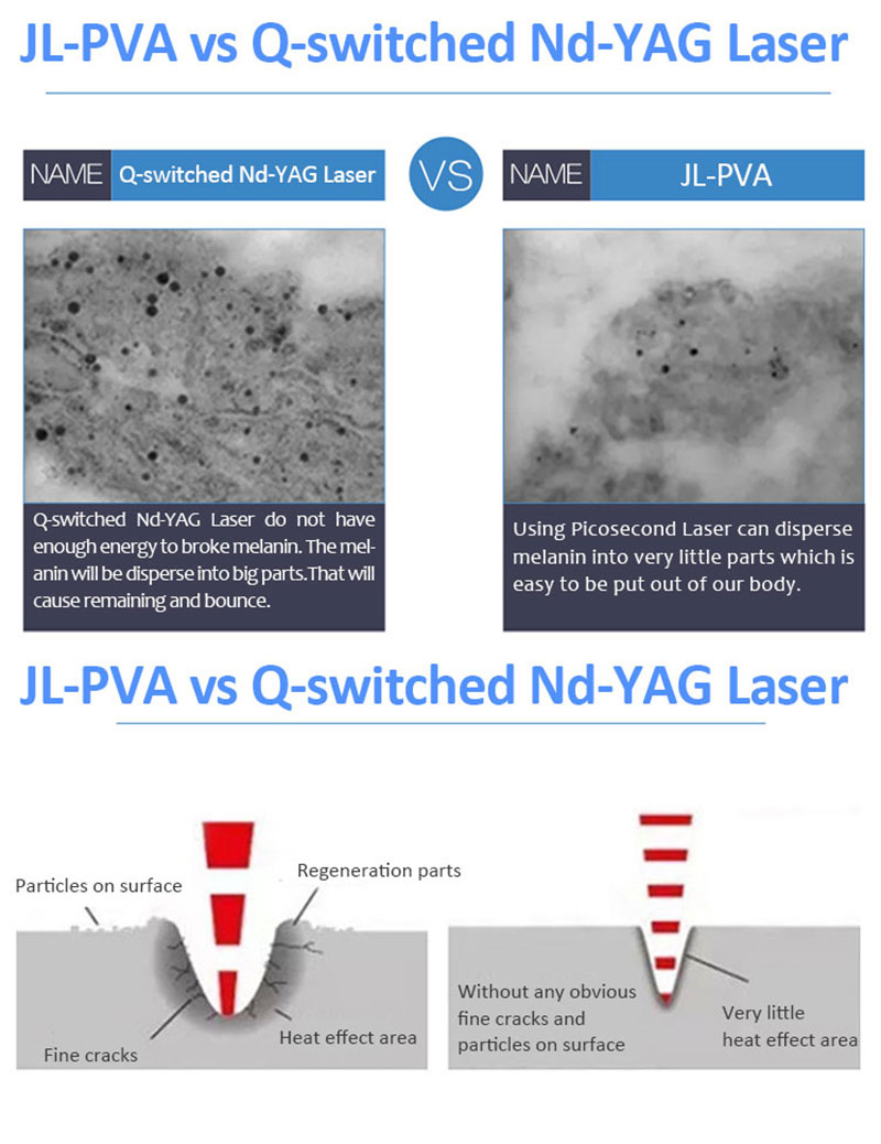 JL-PVA Пиколазер/Пикосекундный лазер Удаление пигментных поражений и татуировок/Удаление возрастных пятен, хлоазмы, веснушек/Машина для омоложения кожи