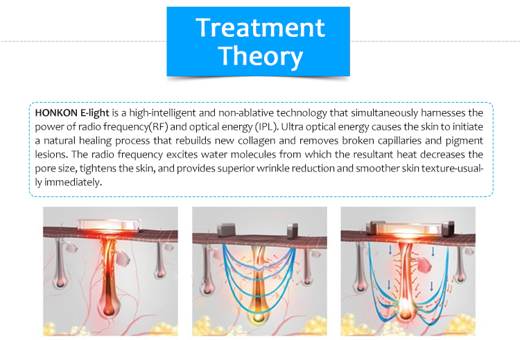 M40e+ Depilación portátil IPL/E-Light Rejuvenecimiento de la piel Bipolar RF Estiramiento y elevación de la piel