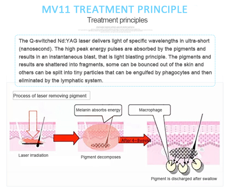 Láser ND:YAG con conmutación Q de 1064 nm, máquina de eliminación de tatuajes con láser, máquina de eliminación de lesiones pigmentarias, MV11