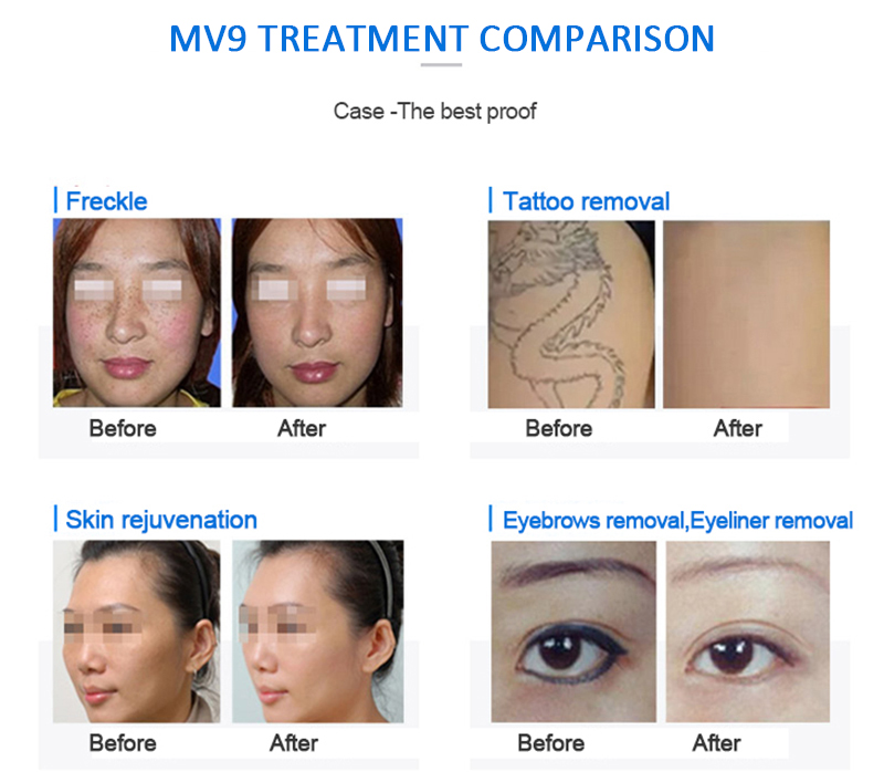 mv9beforeandafter