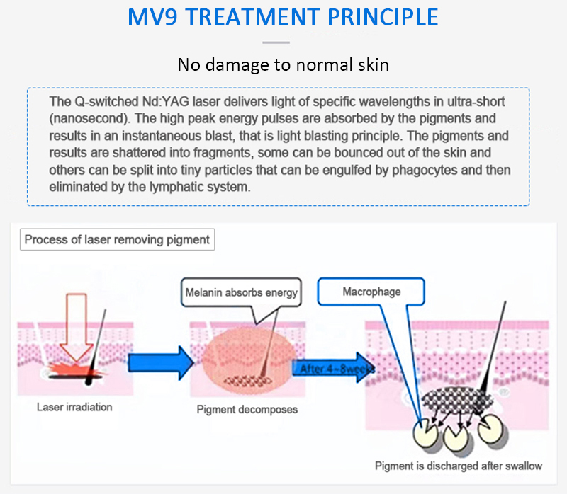 1064nm Q-Switched ND:YAG Laser, Laser Tattoo Removal Machine, Pigment Lesions Removal Machine, MV9