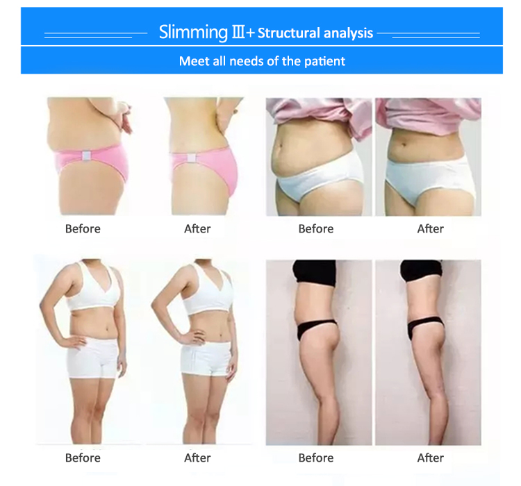 slimming3+beforeandafter