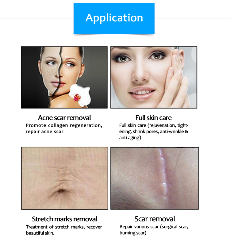 SM10600AL-30b Cost-Effective 10600nm CO2 Fractional Laser Vaginal Tightening Skin Resurfacing And Stretch Marks Removal